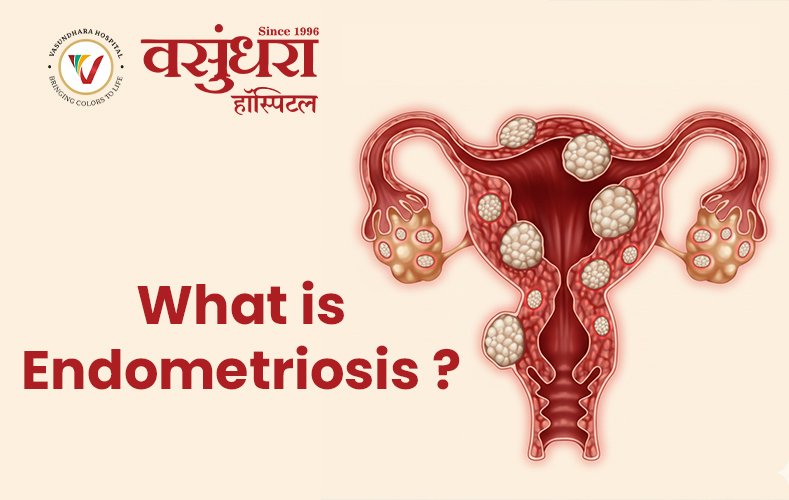 what is endometriosis